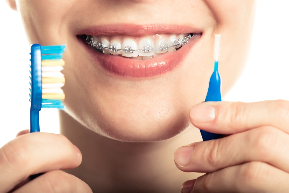 Consejos para cuidar tu sonrisa con brackets