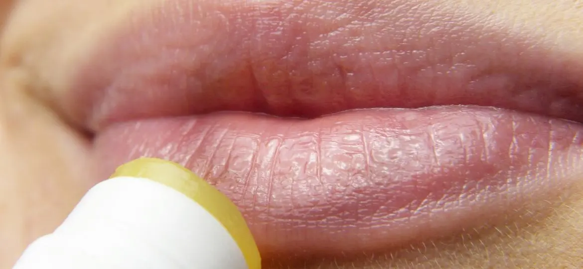 Herpes labial - Clínica Bajo Herpes labial: síntomas y tratamiento