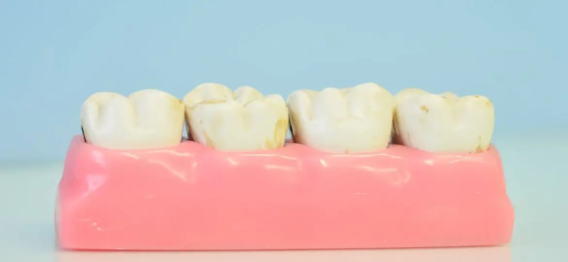 El desgaste dental, ¿qué lesiones lo provocan?
