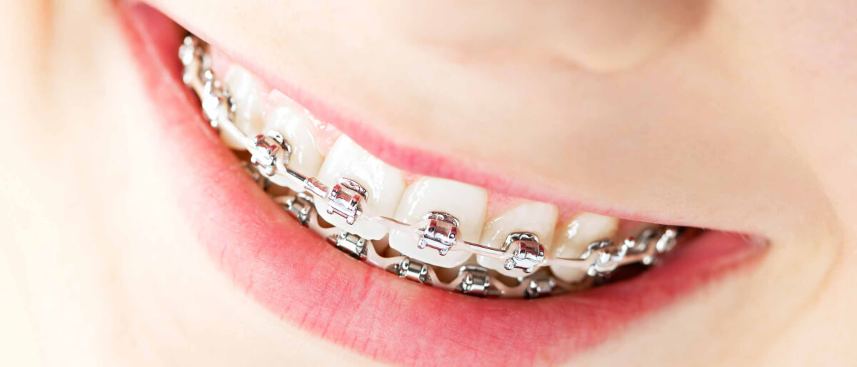 Mitos y verdades sobre la ortodoncia