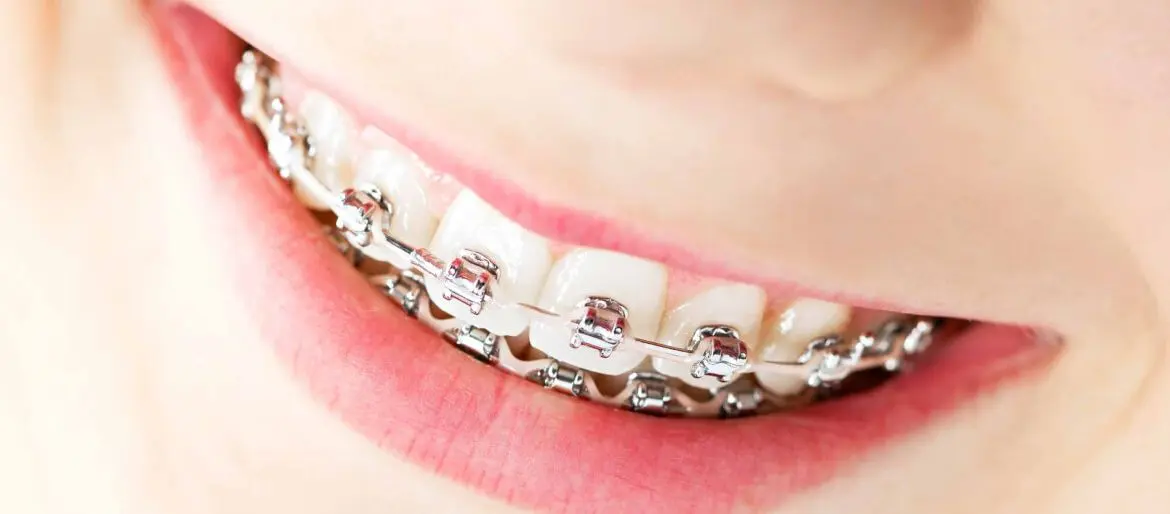 Mitos y verdades sobre la ortodoncia