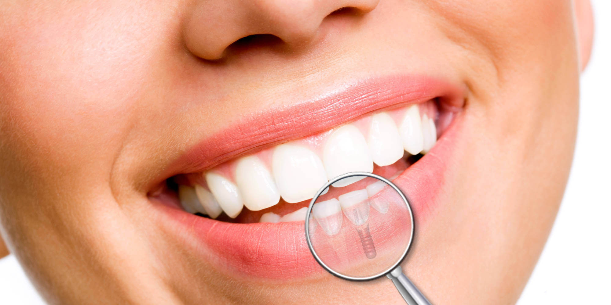 Recomendaciones tras la colocación de implantes dentales