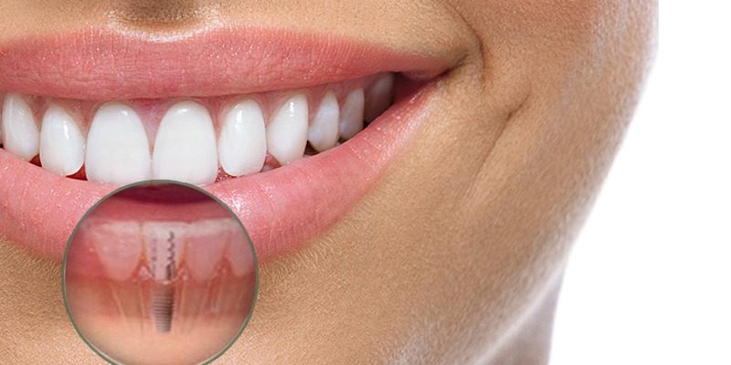 Implantes dentales. Las preguntas más frecuentes