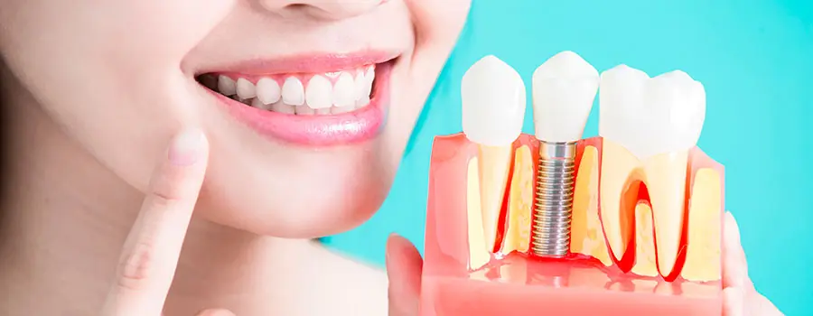 Puente fijo o el implante - Clínica Bajo ¿Puente fijo o el implante? Razones para saber elegir