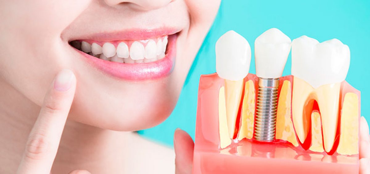 ¿Puente fijo o el implante? Razones para saber elegir - Clínica Dental Bajo