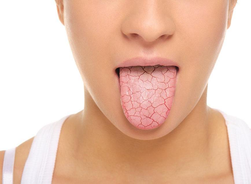 Síndrome de la boca seca ¿qué es exactamente?