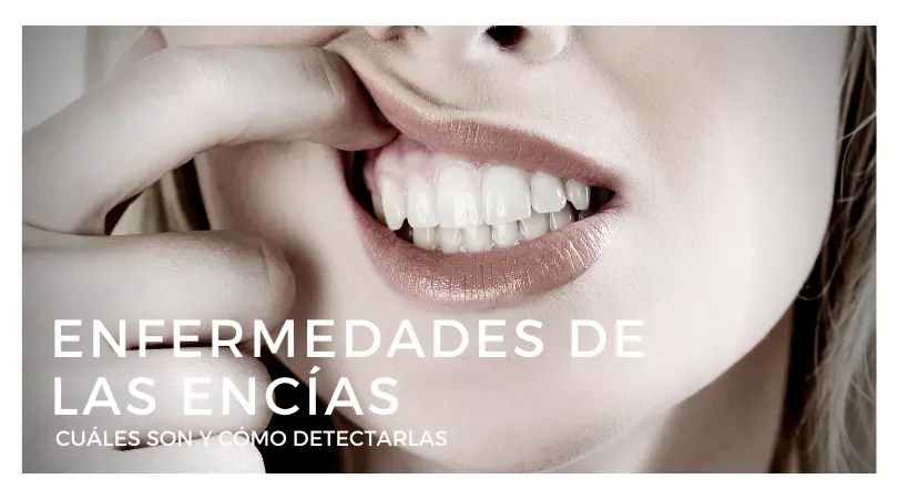 Enfermedades de las encias - Clínica Bajo Enfermedades de las encías, cuáles son y cómo detectarlas