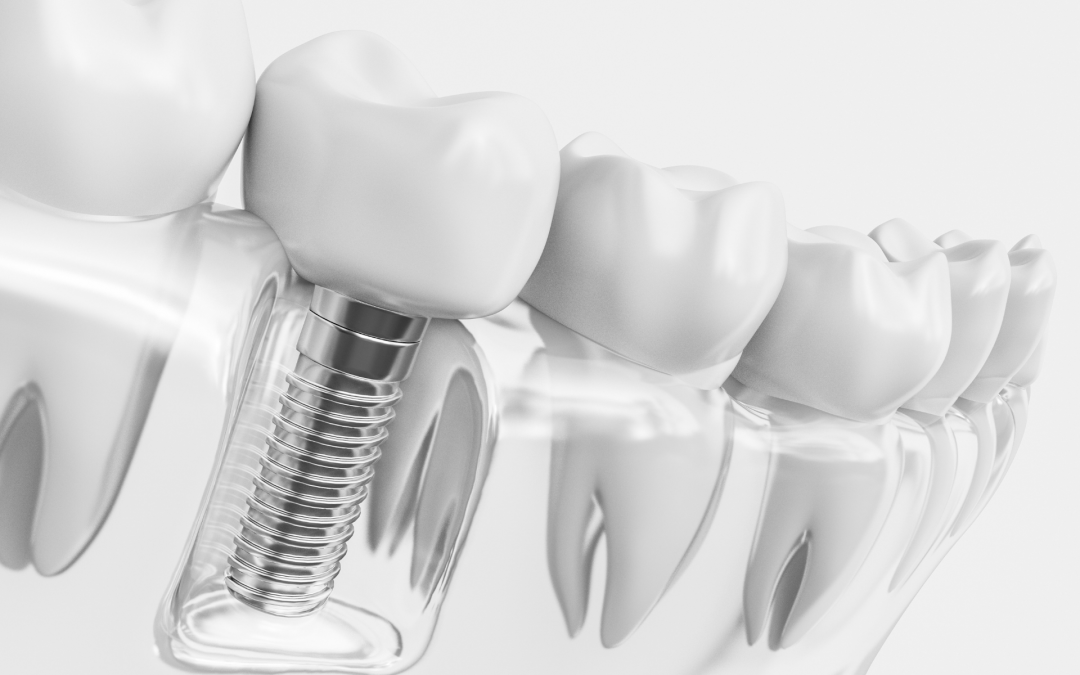 Implantes dentales: todo lo que debes saber