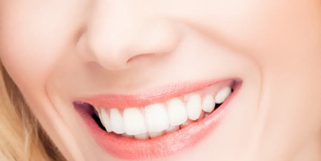 Treatment of closing black spaces between teeth with dental aesthetics in a clinic in Los Cristianos, Tenerife.