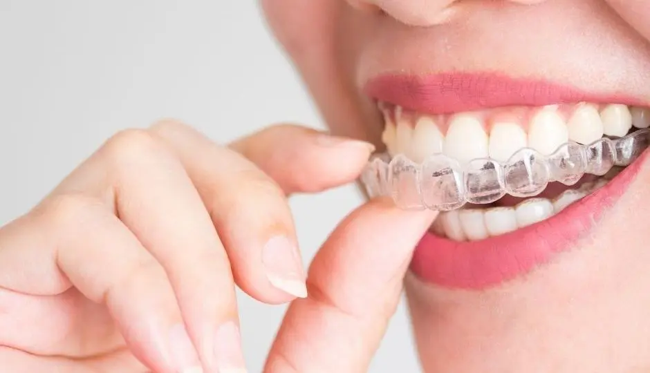 Ortodoncia invisible: ¿qué modelos nos podemos encontrar?