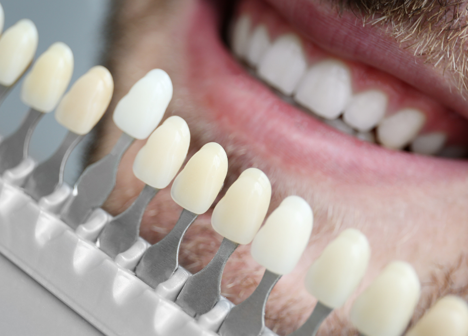 Carillas dentales, ¿qué son y para qué se utilizan?