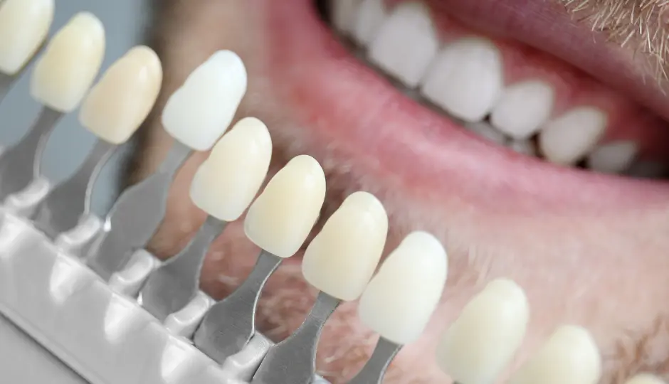 Dental aesthetic treatment with porcelain dental veneers in dental clinic in Los Cristianos, Tenerife.