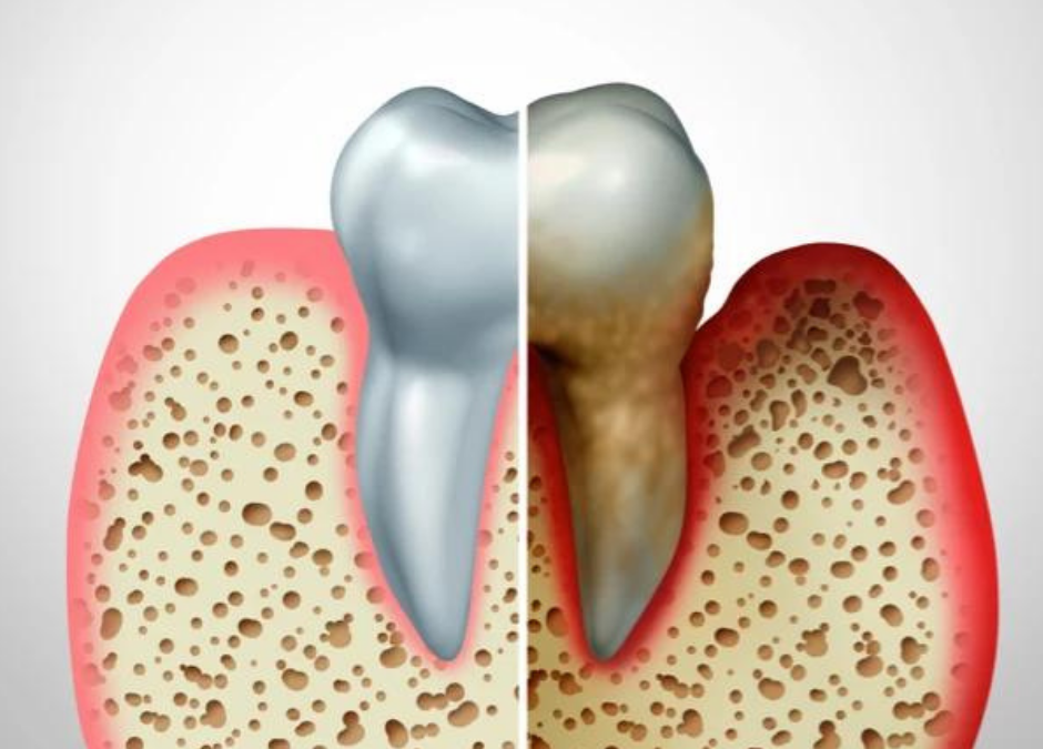 Dental bone loss, how to prevent it?