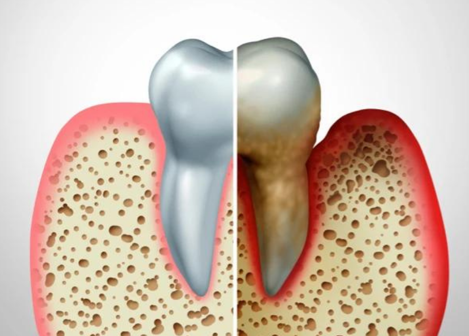 ￼Pérdida del hueso dental, ¿cómo prevenirlo?