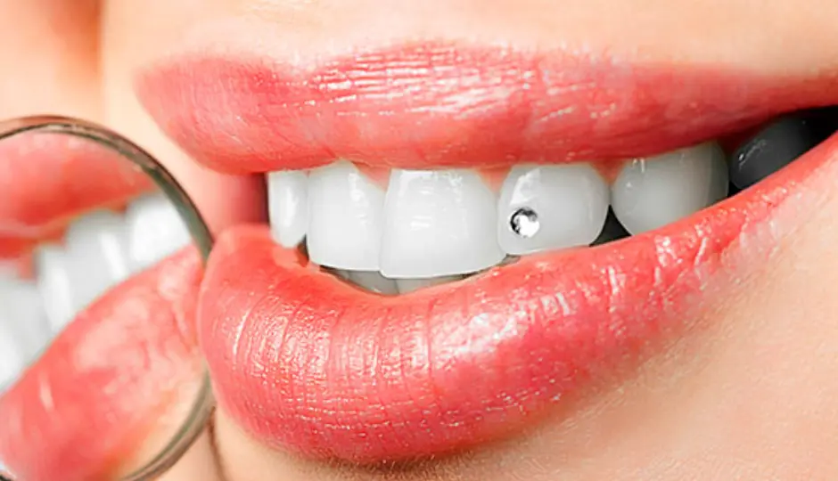 Joyas dentales - Clínica Bajo Joyas dentales: el riesgo de una moda