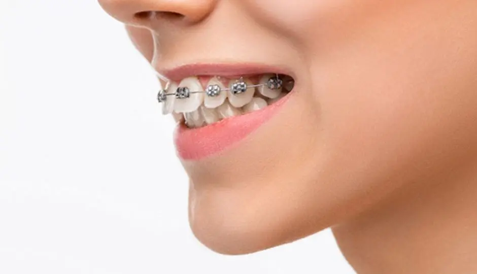 Mordida abierta en Tenerife - Clínica Bajo Mordida abierta, ¿qué es y por qué es importante corregirla?