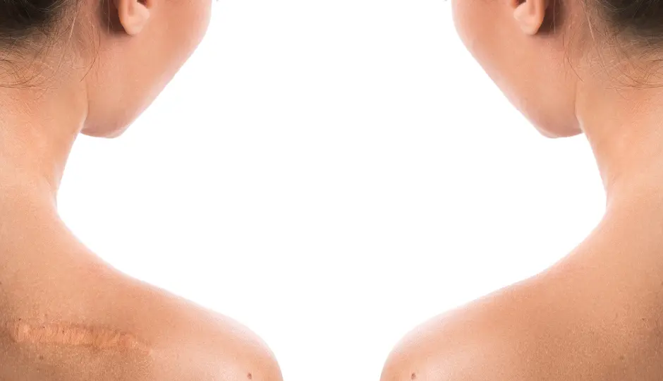 Cicatrices - Clínica Bajo Cicatrices, ¿se pueden eliminar con medicina estética?