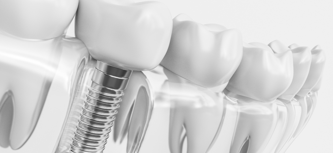 Implantes dentales: todo lo que debes saber