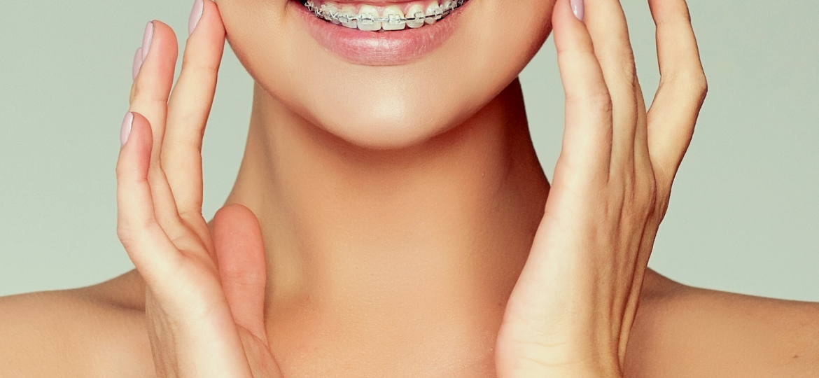 ¿Qué podemos comer con brackets?