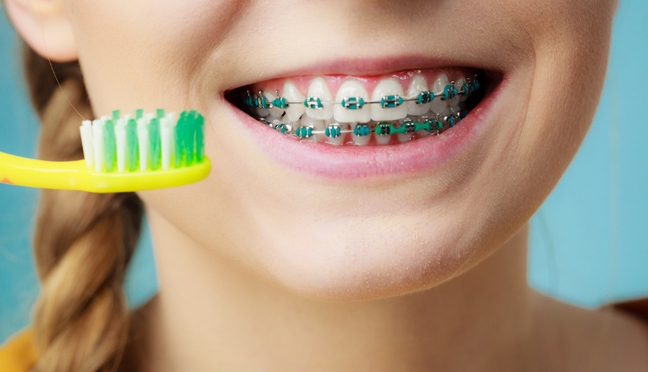 Las claves del cepillado con bracktes
