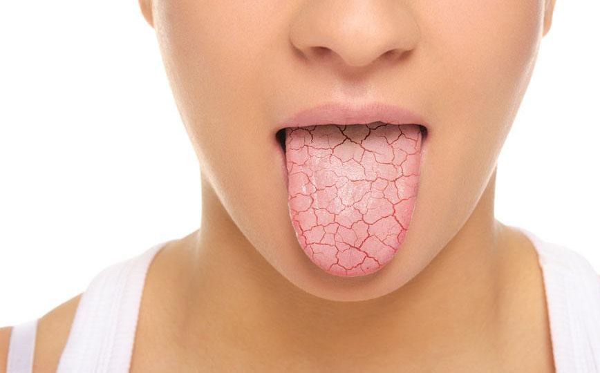 Síndrome de la boca seca ¿qué es exactamente?