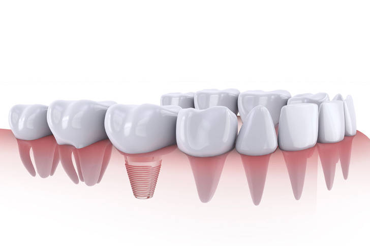 implantes-dentales
