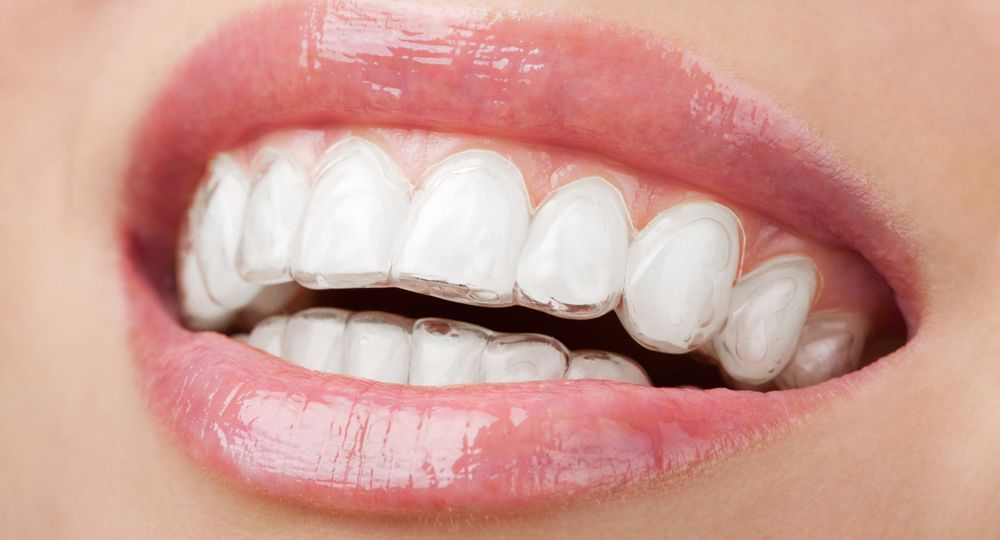 ¿Sonrisa perfecta sin brackets? Descubre la ortodoncia invisible