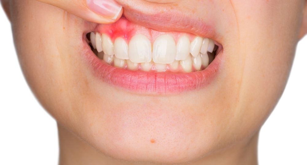 Conoce un poco más sobre la enfermedad periodontal