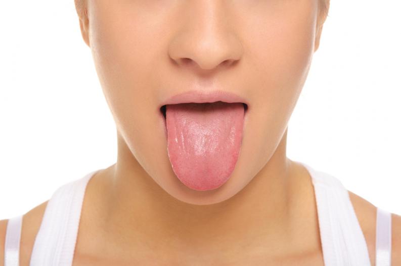 Lengua agrietada