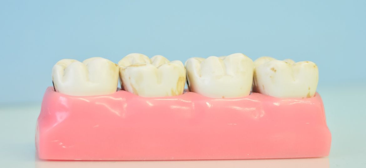El desgaste dental