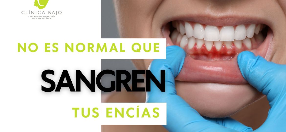¿Por qué sangran tus encías?