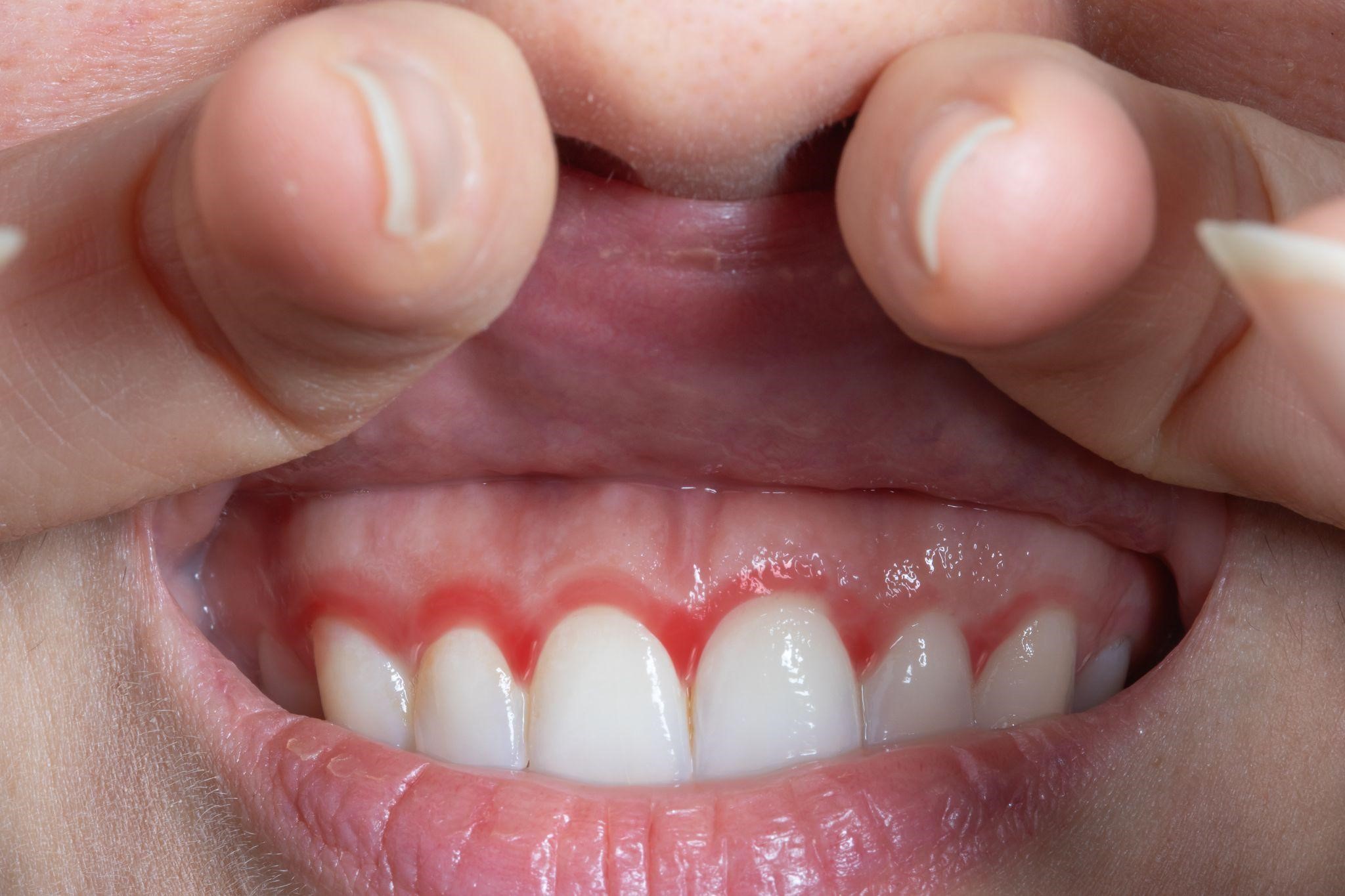 periodontitis Higiene periodontal profesional en Clínica Bajo Sondaje periodontal con Sonda Florida Cepillos interproximales para cuidado interdental
