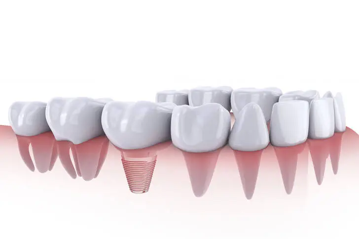 Implantes Dentales en Tenerife Sur - Clínica Bajo