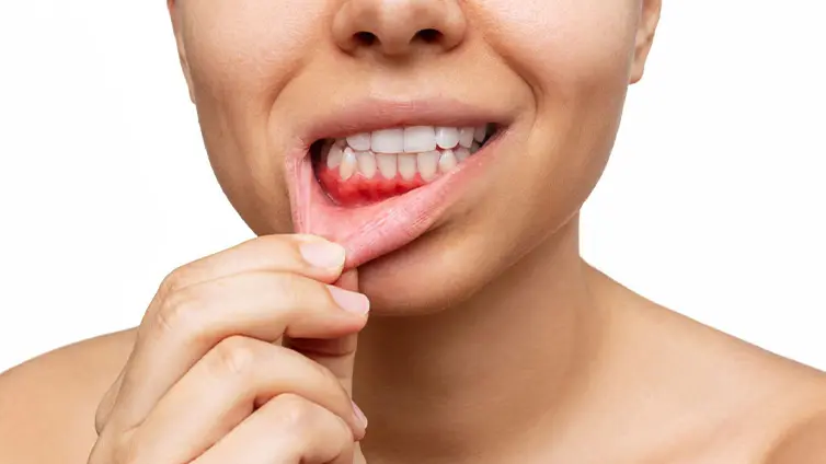 Periodontitis: encías y cerebro, una conexión que no debes ignorar